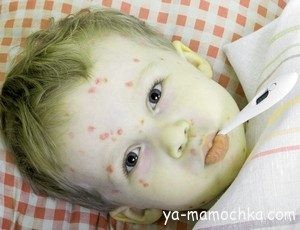 Корь - давняя болезнь в современных условиях