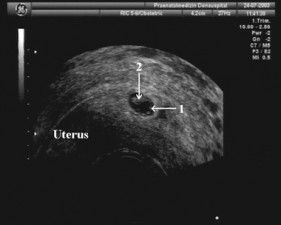 Признаки беременности на УЗИ: внематочная; многоплодная; замершая
